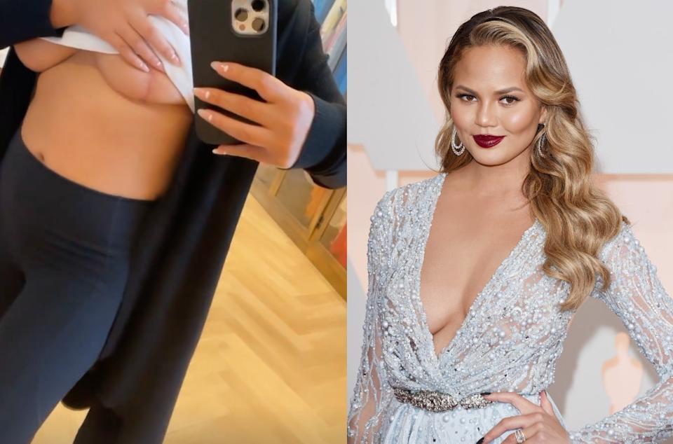 Chrissy Teigen Embodies Empowerment inImplant Removal Journey.